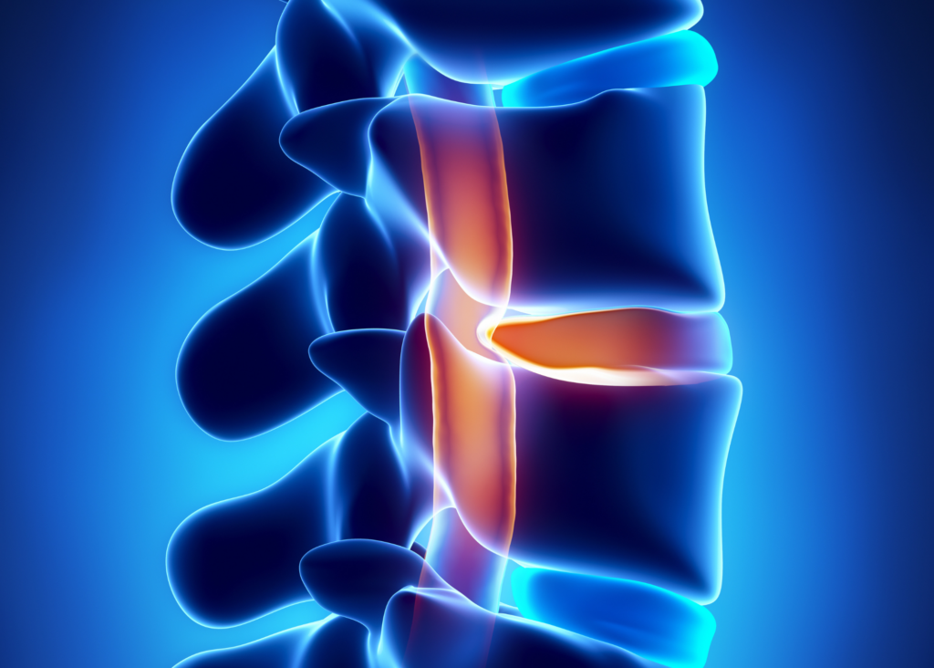 The spinal cord serves as a conduit for sending signals and messages from the brain to all parts of the body. The spinal cord is a complex system that is part of everything we do. If the spinal cord is damaged, the message from the brain cannot get through leaving the affected area unable to move or function. Spinal cord injuries are one of the most dangerous injuries as they can lead to paralysis or life threatening conditions. According to research, approximately 17,000+ new cases of spinal cord injuries occur each year in the United States. A spinal cord injury can happen to anyone at any age but the majority of the injuries occur in people between 16 to 30, and male account for about 80% of the new cases. This article contains an overview of spinal cord injuries, their causes, types, levels, treatments, and tips to prevent them from happening. What is spinal cord injury? A spinal cord injury refers to the damage to the spinal cord resulting from sudden blow, trauma, disease, or degeneration. Depending on the severity, people with spinal cord injuries may lose essential function or mobility in different parts of the body. A damaged spinal cord can affect: Breathing Heart rate Metabolism Reflexes Sensation Muscle movement Bladder and bowel function Types of spinal cord injury There are different ways injuries happen and can have different causes. In most cases, spinal cord injuries can be categorized into two types: Complete “Complete” spinal cord injuries are the most serious and occur when the patient has lost all the feeling (sensory) and all the ability to control movement (motor function) below the injury site. Incomplete “Incomplete'' spinal cord injuries are increasingly common and occur when the patient has some sensory or motor function below the injured site. Because the spinal cord is partially-compromised, injuries may vary from person to person depending on the severity. Levels of spinal cord injury The spinal cord is divided into 4 sections: cervical, thoracic, lumbar, and sacral. Learn each section of the spine, the level injury, and severity: Cervical spinal cord injuries This type of injury affects the head and neck area above the shoulder. The higher the level of injury on the spinal cord, the more severe it can become. Therefore, this is the most severe level of spinal cord injury. Thoracic spinal cord injuries This type of injury usually affects the abdominal muscles, upper chest, and mid-back of the body. With this level of spinal cord injury, arms and hand function are usually normal. Lumbar spinal cord injuries This type of injury mostly affects the legs and hips. With this level of injury, patients may need braces or wheelchairs in order to move. Sacral spinal cord injuries This type of injury affects the buttocks, pelvic organ, hips, and the back of the thighs. With this level of spinal cord injury, patients are most likely able to walk and function. What are the symptoms of spinal cord injury? If a spinal cord injury is not easily recognized, a more severe injury may occur. There are symptoms that may occur immediately, while some may come gradually. Some of the possible symptoms of spinal cord injuries include: Headache Bedsores Breathing problems Extreme back pain Severe pain in the neck An oddly positioned or twisted neck or back Muscle weakness Abnormal reflexes Numbness or loss of sensation Loss of bladder or bowel control Difficulty with balance or walking The symptoms described above may look like other medical conditions or problems. So, if you suspect someone has a spinal cord injury, keep the person still and call for medical help. Neuro rehabilitation centers are available to provide proper treatment and on-going care for people suffering from spinal cord injury. What are the causes of spinal cord injury? In the United States, motor vehicle accidents are the leading cause of spinal cord injuries in younger individuals, while fall is the leading cause for people over 65. Other reported causes of spinal cord injuries includes: Motor vehicle accident (39%) Fall (31%) Violence (13%) Recreational activities (8%) Medical or surgical (4%) Specific type of infections Certain types of cancer How to treat spinal cord injuries? A spinal cord injury is a serious medical condition that requires comprehensive evaluation, treatment, and rehabilitation. The recovery time depends on the severity of the injury. The initial treatment may include medication, surgery, and other medical procedures while long-term treatment plans include on-going care and rehabilitation programs. Read more about spinal cord injury rehab. How to prevent a spinal cord injury? Though it’s impossible to prevent spinal cord injuries, there are general safety practices you can do to reduce your risks of getting one, or the people around you. Some risk-reducing measures include: Always wear your seatbelt while in a car Never drive under the influence of alcohol or drugs Keep your house clean and away from any hazard that could lead to a fall or slip Use safety equipments and wear protective gear when playing sports Don’t dive in shallow water Never play or push anyone into a swimming pool Avoid extreme sports such as sky diving, bungee jumping, etc. NeuLife Rehab – Providing the best rehabilitation for spinal cord injuries. If you’re looking for a patient-centered rehab for you or a loved one, then you’re on the right track! At NeuLife, we provide effective and research-based rehabilitative services to address your serious issues. Your care will be based entirely on your injury, situation and body, designed around your capabilities and proceeding at your speed. Your physical and mental health will be addressed, as the therapy covers a myriad of topics, from diet and nutrition, to relationship skills, to occupational therapy. Besides spinal cord injury rehabiliation, we also provide other types of rehabilitative treatment, such as: Traumatic brain injury rehabilitation Neurologic rehabilitation center Complex orthopedic rehabilitation And more! Contact us now at 800-626-3876 to learn more about our programs or schedule a tour to see our stunning in-patient facility. The material contained on this site is for informational purposes only and DOES NOT CONSTITUTE THE PROVIDING OF MEDICAL ADVICE, and is not intended to be a substitute for independent professional medical judgment, advice, diagnosis, or treatment. Always seek the advice of your physician or other qualified healthcare providers with any questions or concerns you may have regarding your health.